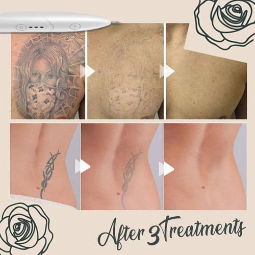 Anti Aging Instant Freckle Dot Mole Dark Sp Ot Tattoo Removal Pen Buy Anti Aging Instant Freckle Dot Mole Dark Sp Ot Tattoo Removal Pen Prices Reviews Zoodmall