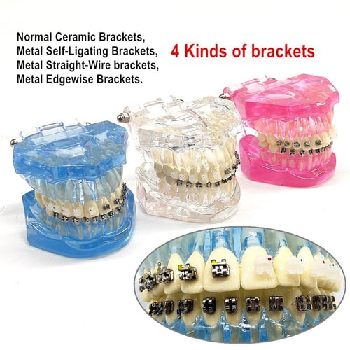 1 piece Dental Orthodontic Model Patients Communication 4 kinds Brackets  with Ceramic Bracket Metal Self Ligating Brackets - buy 1 piece Dental  Orthodontic Model Patients Communication 4 kinds Brackets with Ceramic  Bracket